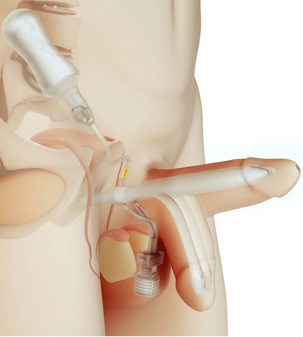 What is Penile implant (Penile prostheses or Mutluluk Çubuğu)?
