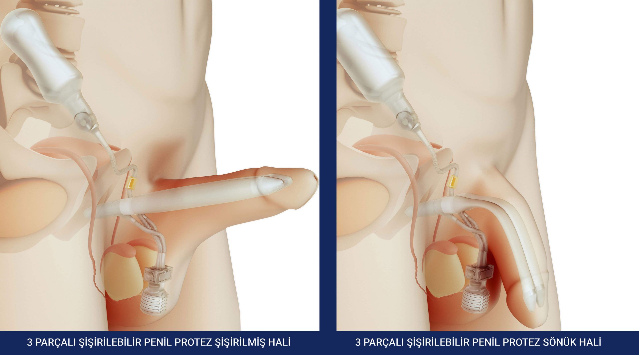 3 Parçalı Penil Protez: Kapsamlı Tedavi Rehberi